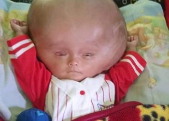 Mirisnya Sejak Lahir Bocah Berumur 8 Bulan Mengalami Penyakit Hidrosefalus